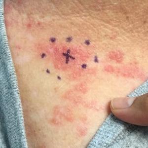  Clavicular region with erythematous papules and plaques at the base of the neck