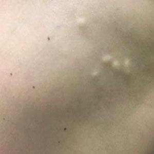 Multiple firm, nontender, flesh-colored to white nodules on the thigh
