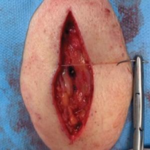Assisted wound edge approximation utilizing a surgical assistant for bidirectional wound apices traction method for contralateral second pass suture location