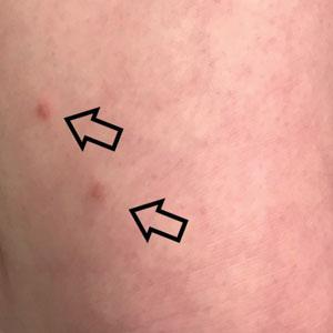 Numerous sclerotic papules (arrows) consistent with dermatofibromas