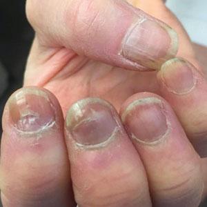  Beau lines, transverse leukonychia, and onychomadesis 6 weeks after the second dose of the Pfizer-BioNTech COVID-19 messenger RNA vaccine 