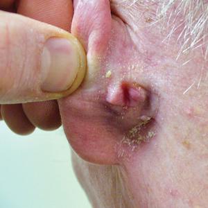 Pink nodule behind the ear