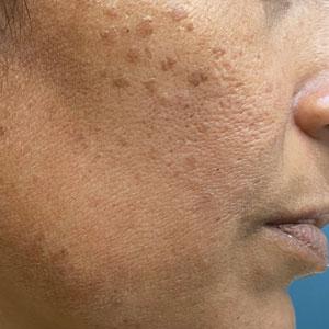 Pigmented papules on the face