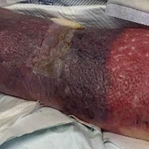 Erythema on the dorsal aspect of the left hand and forearm with a well-demarcated, dusky blue hue, surrounded by an erythematous border on the proximal forearm and upper arm.