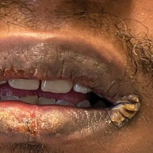 Cutaneous eruption
