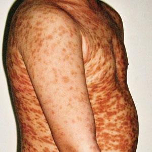 Itchy red-brown spots on a child