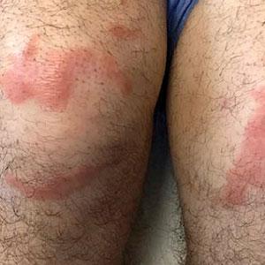 Multiple annular erythematous plaques