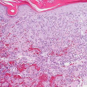 Rapidly growing nodule within a previously radiated area of the scalp