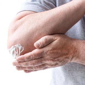 Psoriasis
