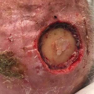 Bone wax in place and providing hemostasis at the bandage change.