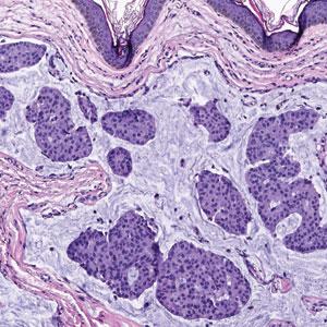 Dome-Shaped Periorbital Papule | MDedge