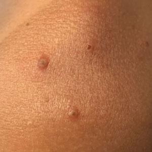 Centrally umbilicated crusted papules on the left shoulder overlying hyperpigmented sun-exposed skin, sparing sun-protected skin.