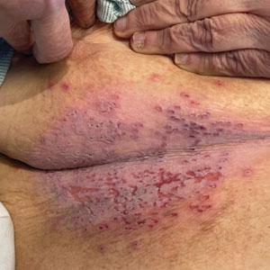 Widespread erosions in intertriginous areas