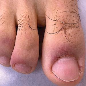 Chilblainlike lesions (so-called COVID toes) manifested with red-violaceous macules over the distal toes.