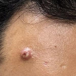 A pink papule with overlying pustules and crusting on the forehead.