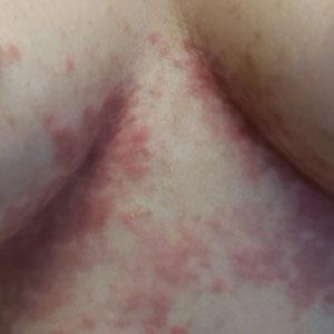 Papular reticulated rash