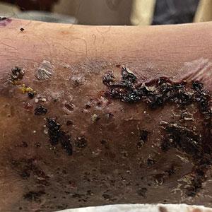 Wounds