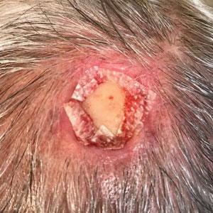 An extracellular matrix–based collagen dressing (Endoform Natural Restorative Bioscaffold [Aroa Biosurgery Inc]) was applied to the wound. 