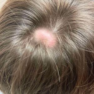 Scalp nodule associated with hair loss