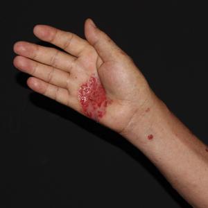An ulcerated plaque with ragged borders and abundant central neoepithelialization on the right palmar surface.