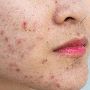 Acne