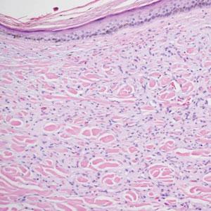 Painful, Nonhealing, Violaceus Plaque on the Right Breast | MDedge