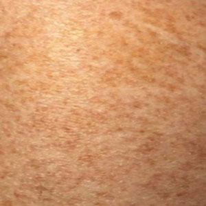 Schamberg disease