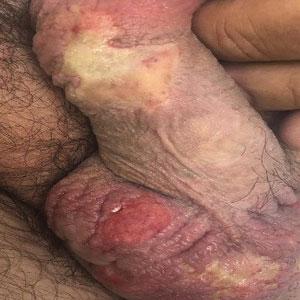 Multiple scrotal and penile ulcers that the patient self-treated with a local anesthetic cream containing lidocaine 2.5% and prilocaine 2.5%.