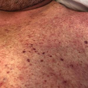 Papular edematous rash on the chest upon restarting the trial of palifermin.