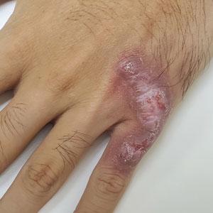 Violaceous plaque on the metacarpophalangeal joints