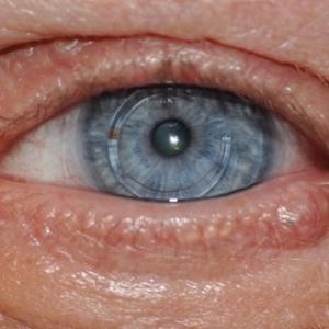 A flesh-colored papule on the left lower eyelid margin diagnosed as an endocrine mucin-producing sweat gland carcinoma (case 2).