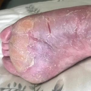 Hyperkeratosis, fissuring, and erythema of the plantar foot before guselkumab was initiated.