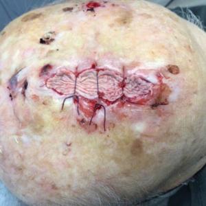 . Pulley guiding sutures (3-0 polyglactin 910) decrease the size of the defect and secure a cadaveric split-thickness skin graft over the remaining exposed periosteum.