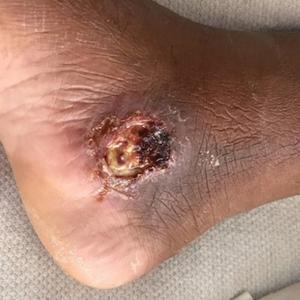A single, 3-cm, ulcerated and crusted plaque with rolled borders on the right medial ankle.