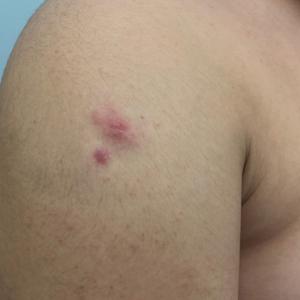 Multiple erythematous dermal papules and a scar at a biopsy site on the right arm prior to treatment.