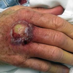 Ulcerating nodule on the dorsal aspect of the right hand with surrounding inflammation.