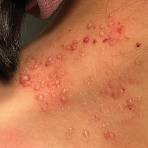 Clustered vesicles on the neck