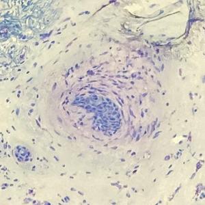 Frozen sections of a basal cell carcinoma (original magnification ×100 for both). 