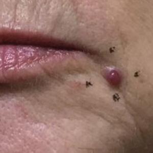 New-onset pyogenic granuloma on the left cheek following combination therapy with paclitaxel and ramucirumab.