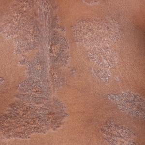 Asymptomatic violaceous plaques on the back