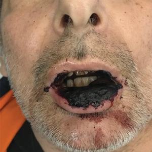 The patient presented with massive necrosis of the lower lip as well as partial necrosis of the upper lip (not shown).