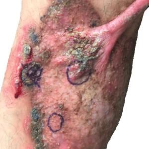 Annular verrucous plaque with central hypopigmentation extending from the medial right leg to the posterior right thigh with keloid formation at the proximal edge.