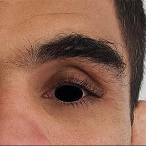 Periorbital Changes Induced by Prostaglandin Eye Drops | MDedge