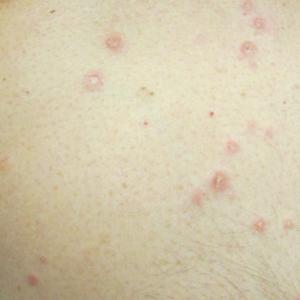 Papules with white atrophic centers and erythematous rims on the anterior trunk