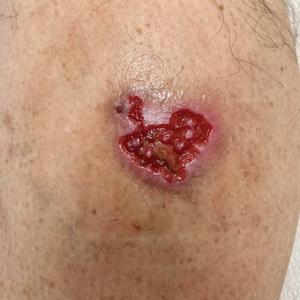 Chronic cribriform ulcerated plaque on the left calf