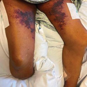 Painful retiform purpura in a peritoneal dialysis patient