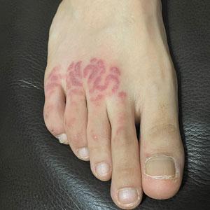 Nonblanching, erythematous, cerebriform plaques on the foot
