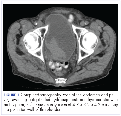 Figure 1 CT scan of the abdomen and pelvis.