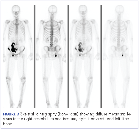 Figure 3 Skeletal scintigraphy (bone scan).
