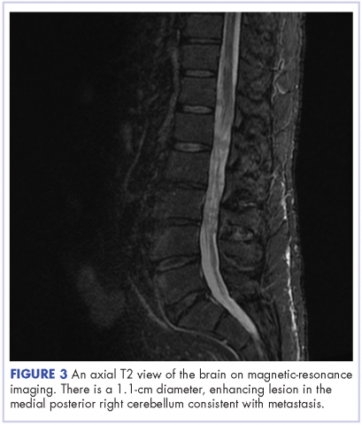 Figure 3 Intramedullary spinal cord and leptomeningeal metastases melanoma - axial T2 view of the brain on MRI